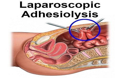 Laparoscopic Adhesiolysis