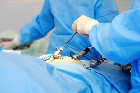Laparoscopy