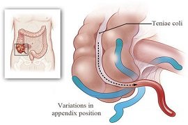 Operative Hysteroscopy (Simple-Adhesiolysis)