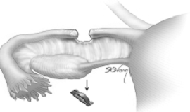 Laparoscopic Sterilization