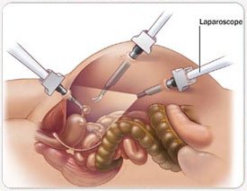 HYSTERO LAPAROSCOPY + ADHESIOLYSIS