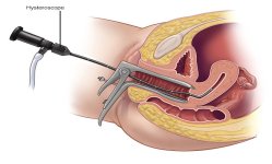 Operative Hysteroscopy (Simple-Polyps)