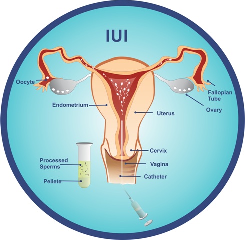 Intra Uterine Insemination