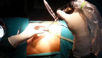 MTP WITH LAPAROSCOPY STERILIZATION