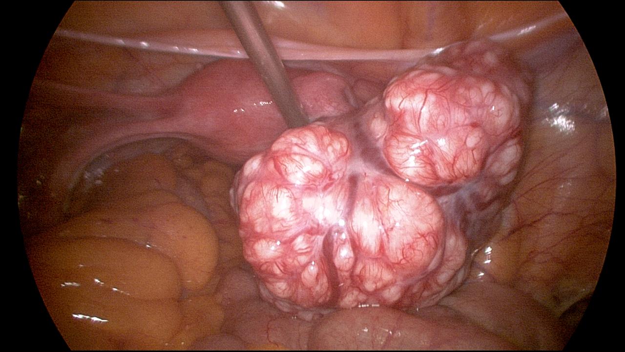 Laparoscopic Myomectomy