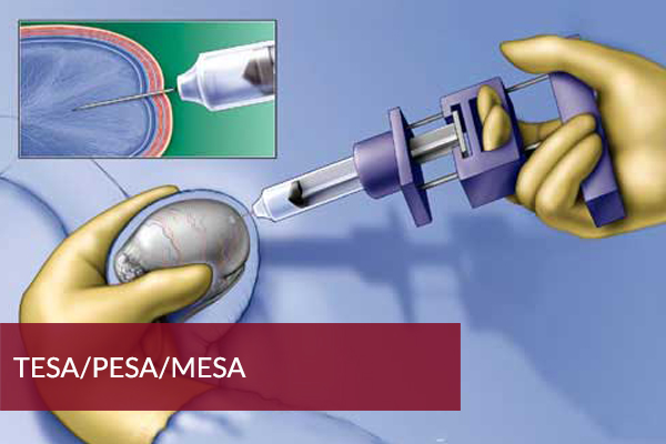 Surgical Sperm Retrival (PESA/TESA)