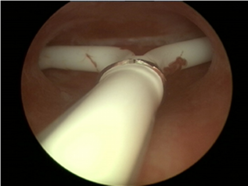 Operative Hysteroscopy (Simple-Coil Removal)