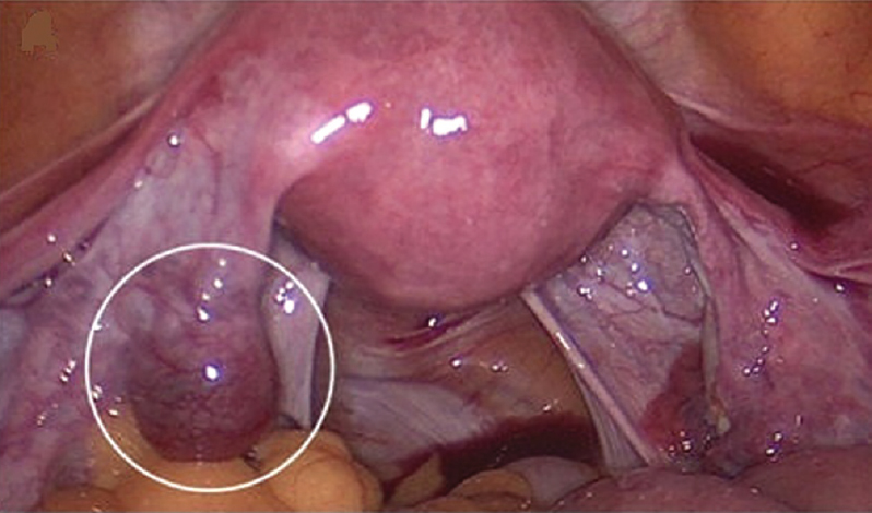 Laparoscopic Salpingectomy (ectopic pregnancy)