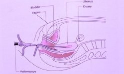 Operative Hysteroscopy (Complex - Asherman)