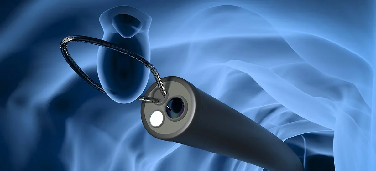 HYSTERO LAPAROSCOPY + OVARIAN CYSTECTOMY