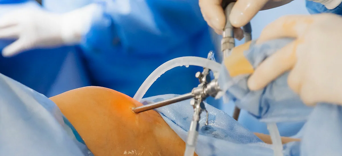 Hystero-Laparoscopy with Endometriosis Treatment & Adhesiolysis