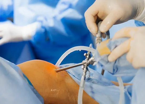 Hystero Laparoscopic + Endometeriotis + Adhesiolysis
