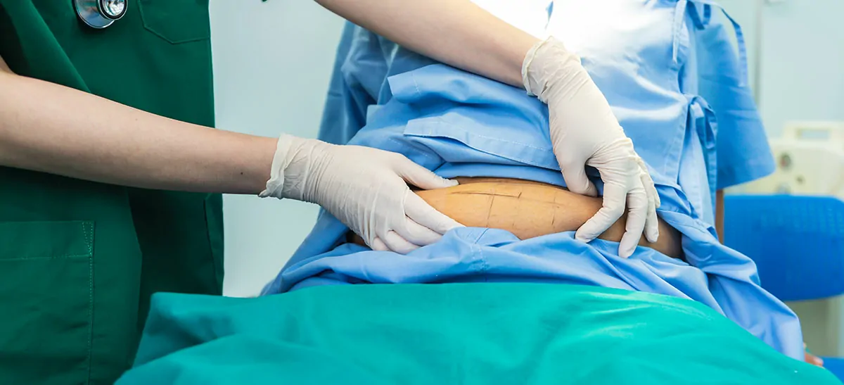 Laparoscopic Salpingectomy (Bilateral)