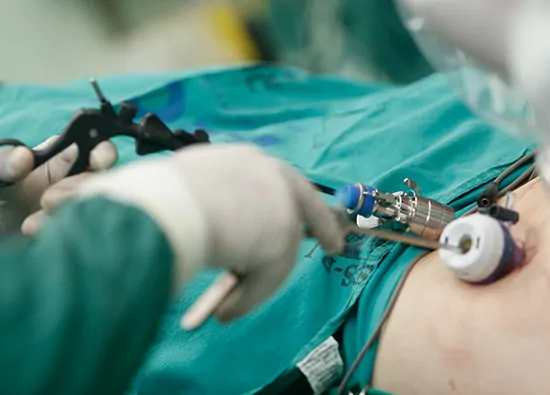 Laparoscopic Adhesiolysis