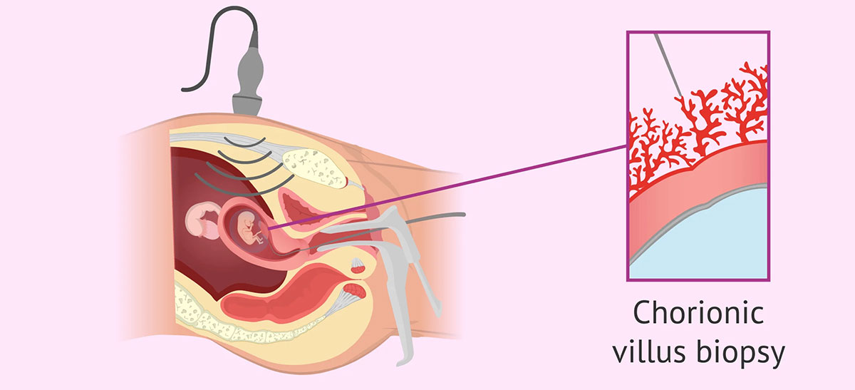 Chorionic Villus Sampling