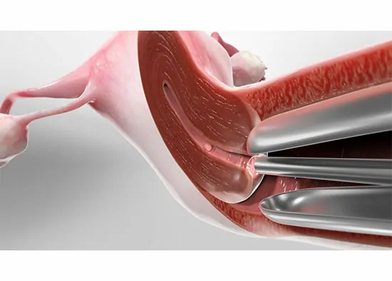 Operative Hysteroscopy (Complex-Fibroid)