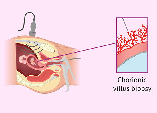 Chorionic Villus Sampling