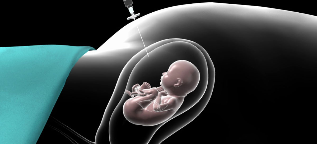 Amniocentesis