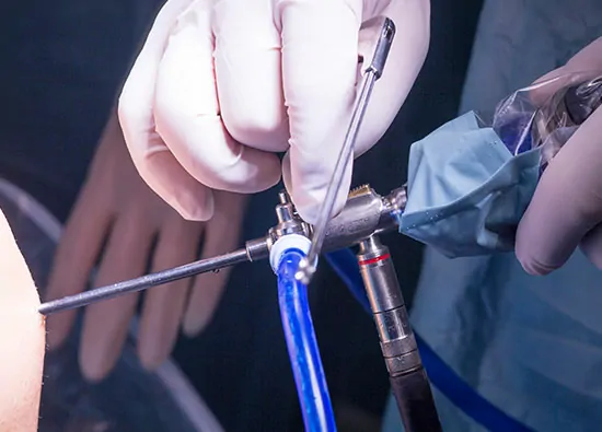 Laparoscopy (Diagnostic) + DYE TEST