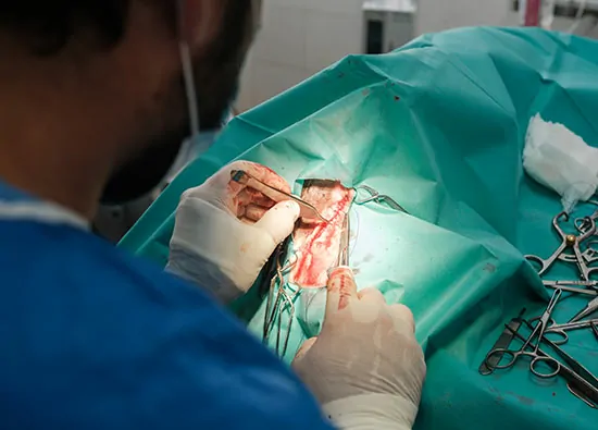 Laparotomy