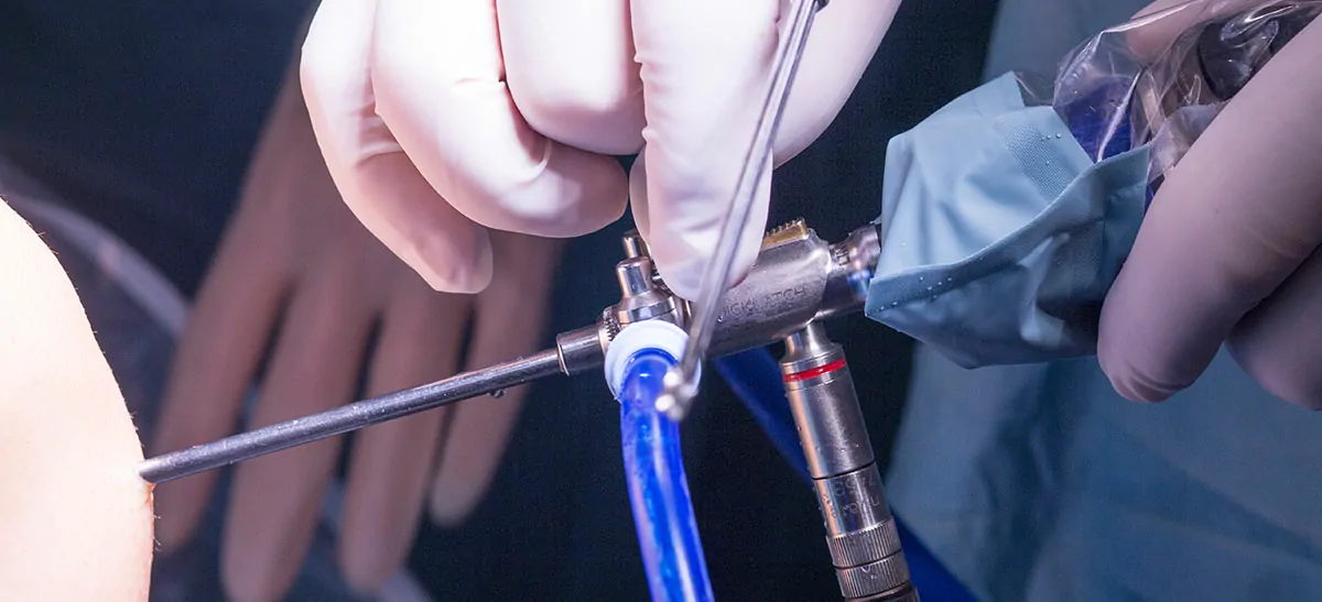 Laparoscopy (Diagnostic) + DYE TEST