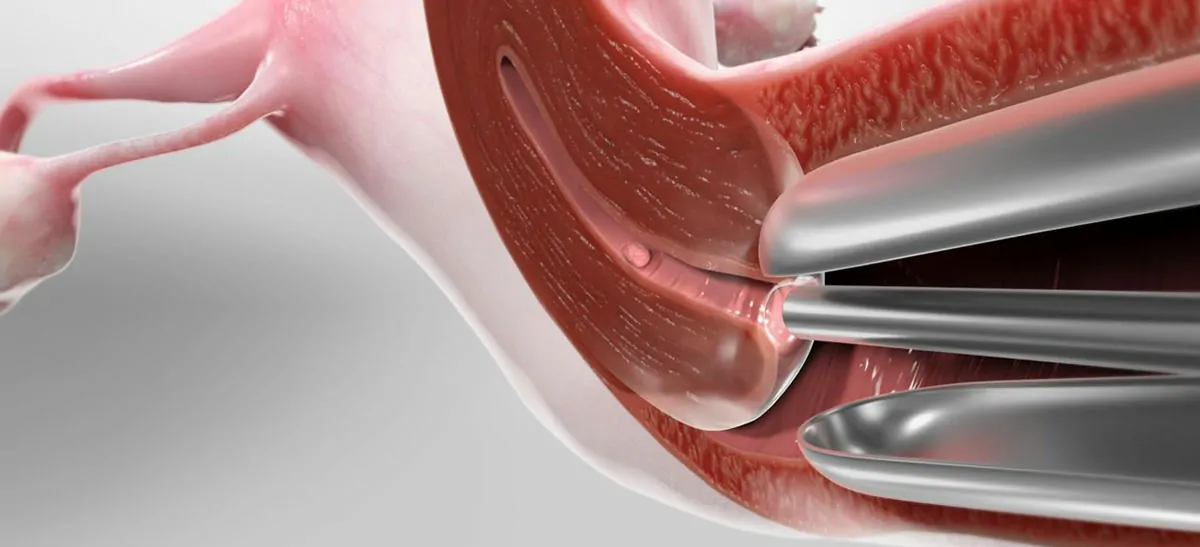 Operative Hysteroscopy (Complex-Fibroid)